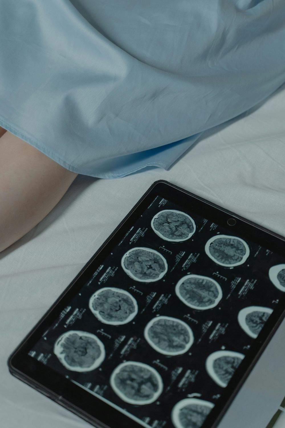 Reduced Grey Matter Linked to Early Psychosis
